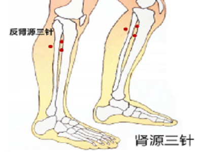 舒氏针灸——肾源三针 /反肾源三针