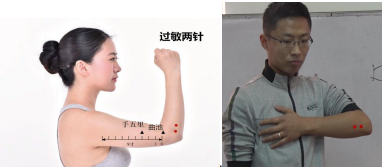 过敏两针.png