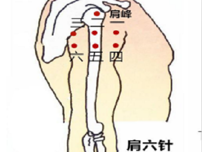 舒氏针灸——肩六针